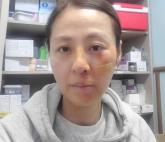 '쇠파이프에 걸려 얼굴 콘크리트 바닥으로 떨어져'...배우 전혜진, 얼굴 부상당한 충격 근황