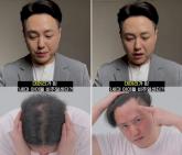 M자 '탈모빔' 맞은 1세대 아이돌 노유민... 모발이식으로 '리즈 시절' 되찾은 근황 공개했다