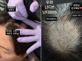 '이솔이♥' 박성광, 대박 소식 전했다... 시술 2주 만에 '원형탈모' 극복