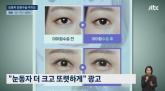 써클렌즈 안 껴도 크고 또렷하게... 요즘 유행 중인 '눈동자 수술', 시력 잃을 수도